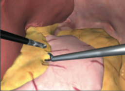 Simbionix LAP Mentor Laparoscopy Gastric Bypass Module