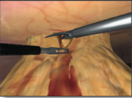 Simbionix LAP Mentor Laparoscopy Incisional Hernia Module